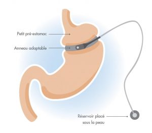 Pose de l’anneau gastrique