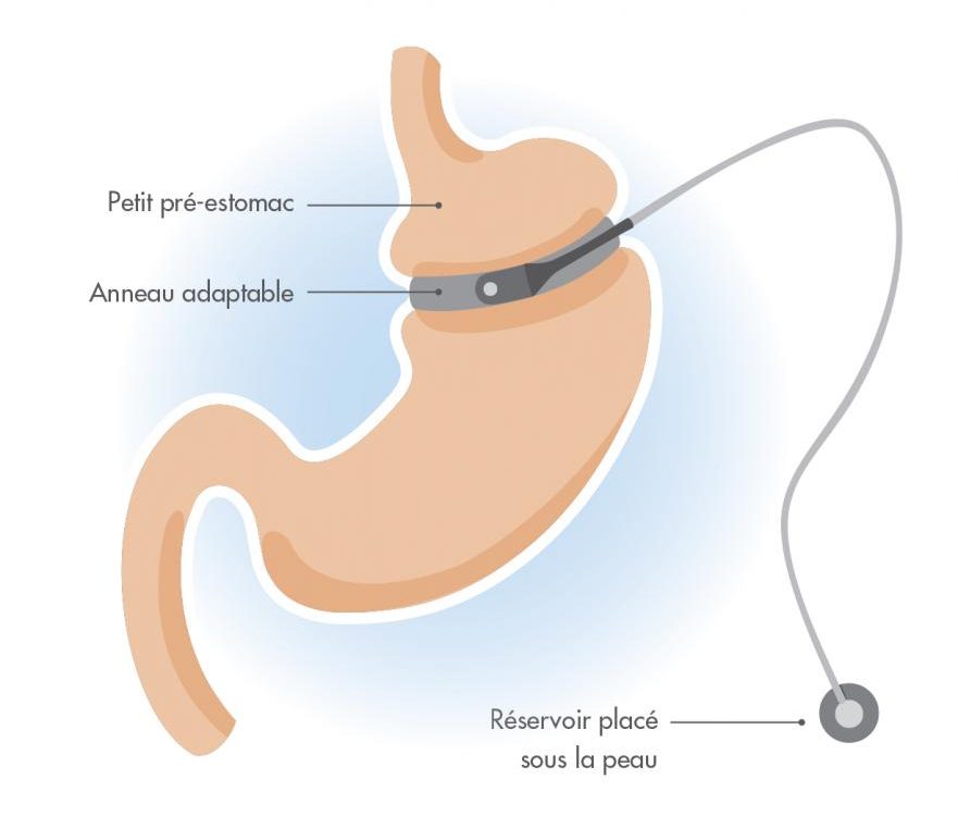 Pose de l’anneau gastrique