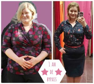 bypass gastrique et mini bypass