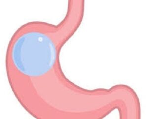 ballon gastrique