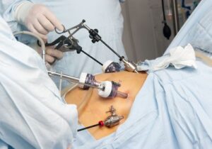 Chirurgie obésité en Tunisie
