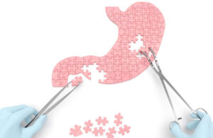 Chirurgie bariatrique pour qui