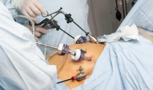 Techniques de la chirurgie bariatrique