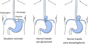 hernie hiatale