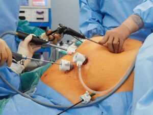 Chirurgie de perte de poids
