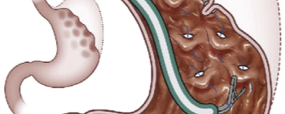 plicature gastrique endoscopique tunisie