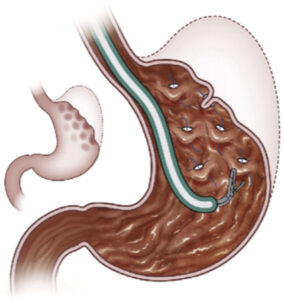 plicature gastrique endoscopique tunisie