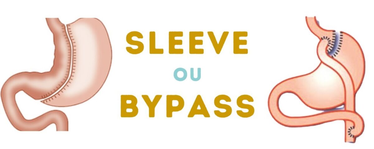 Sleeve gastrectomie ou Bypass gastrique