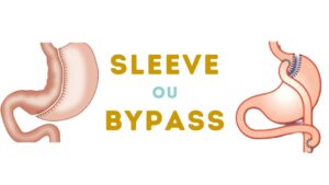Sleeve gastrectomie ou Bypass gastrique