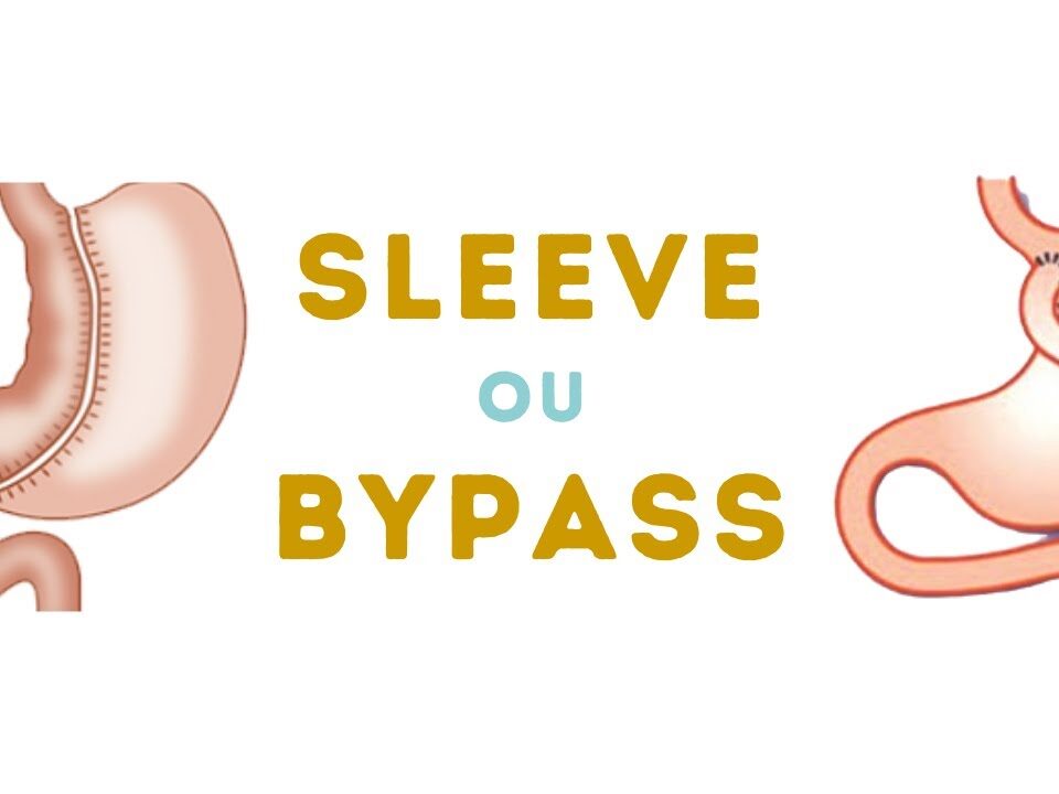 Sleeve gastrectomie ou Bypass gastrique
