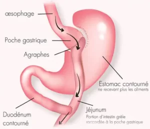 bypass gastrique turquie