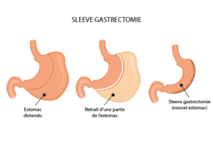 Est-ce que l'estomac repousse après une sleeve gastrectomie