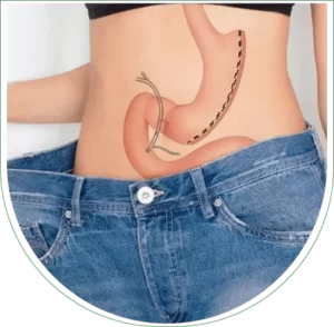 Questions autour de la sleeve gastrectomie