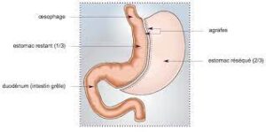 techniques de gastrectomie en manchon