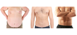 Adaptation à la Vie Après Chirurgie Bariatrique en Tunisie