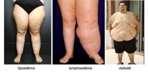 Différence lipoedème lymphoedème et obésité