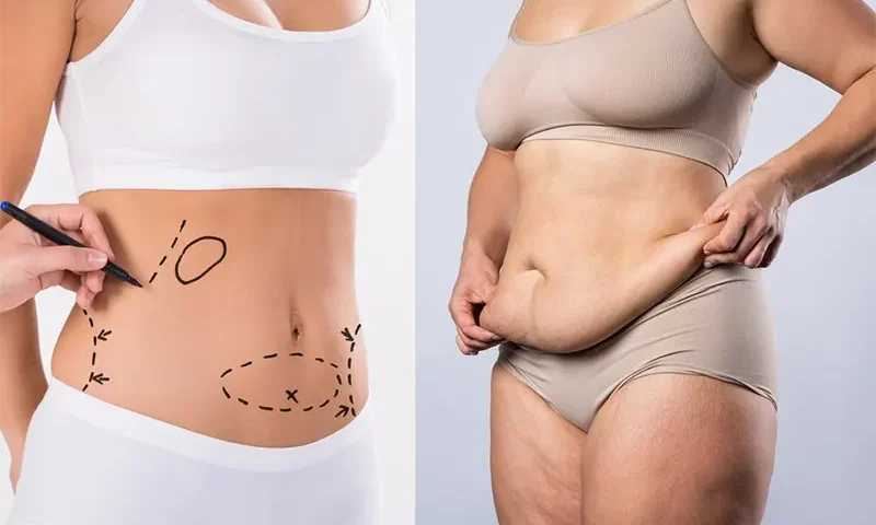 BodyTite après une chirurgie bariatrique