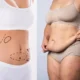 BodyTite après une chirurgie bariatrique